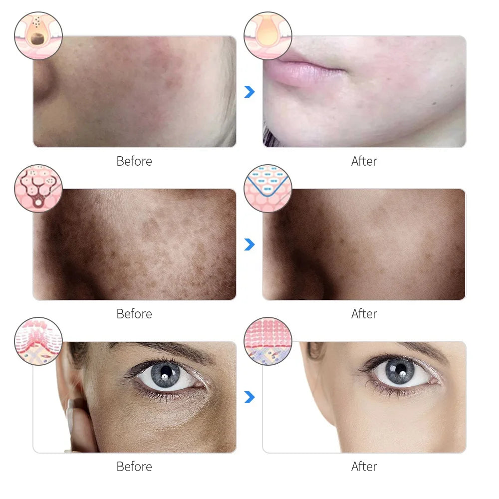 LED Facial Therapy Mask